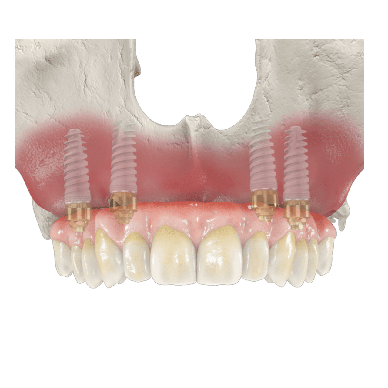 LITE Carga inmediata